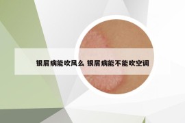 银屑病能吹风么 银屑病能不能吹空调