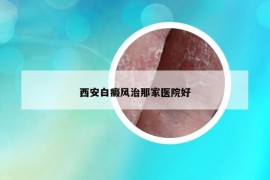 西安白癜风治那家医院好