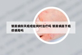 银屑病和天疱疮能同时治疗吗 银屑病属于疱疹病毒吗