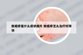 脓疱疹是什么症状图片 脓疱疹怎么治疗好得快