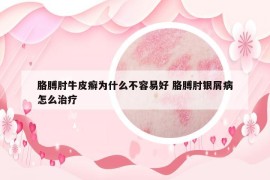 胳膊肘牛皮癣为什么不容易好 胳膊肘银屑病怎么治疗