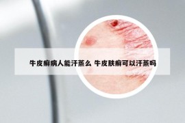 牛皮癣病人能汗蒸么 牛皮肤癣可以汗蒸吗