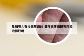 贵阳哪儿有治银屑病的 贵阳银屑病研究院能治得好吗