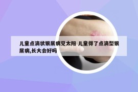 儿童点滴状银屑病见太阳 儿童得了点滴型银屑病,长大会好吗