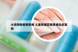 小孩得脓疱银屑病 儿童脓疱型银屑病治愈案例