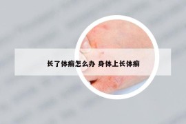 长了体癣怎么办 身体上长体癣