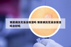 银屑病洗完澡涂保湿吗 银屑病洗完澡涂保湿吗会好吗