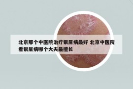 北京那个中医院治疗银屑病最好 北京中医院看银屑病哪个大夫最擅长