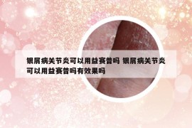 银屑病关节炎可以用益赛普吗 银屑病关节炎可以用益赛普吗有效果吗