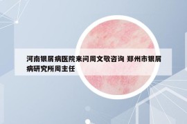 河南银屑病医院来问周文敬咨询 郑州市银屑病研究所周主任