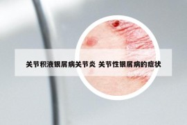 关节积液银屑病关节炎 关节性银屑病的症状