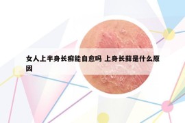 女人上半身长癣能自愈吗 上身长藓是什么原因