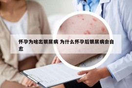 怀孕为啥出银屑病 为什么怀孕后银屑病会自愈