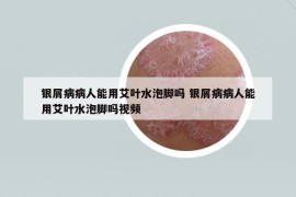 银屑病病人能用艾叶水泡脚吗 银屑病病人能用艾叶水泡脚吗视频