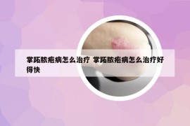 掌跖脓疱病怎么治疗 掌跖脓疱病怎么治疗好得快