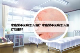 水疱型手足癣怎么治疗 水疱型手足癣怎么治疗效果好