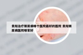 贵阳治疗银屑病哪个医院最好的医院 贵阳银屑病医院哪家好