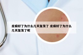 皮癣好了为什么几天复发了 皮癣好了为什么几天复发了呢