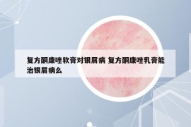 复方酮康唑软膏对银屑病 复方酮康唑乳膏能治银屑病么