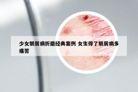 少女银屑病折磨经典案例 女生得了银屑病多痛苦