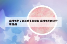 扁桃体割了银屑病多久能好 扁桃体切除治疗银屑病