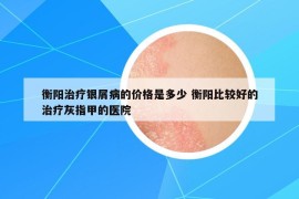 衡阳治疗银屑病的价格是多少 衡阳比较好的治疗灰指甲的医院