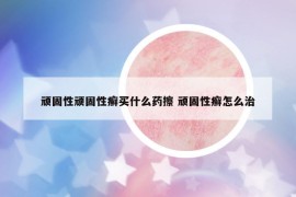 顽固性顽固性癣买什么药擦 顽固性癣怎么治