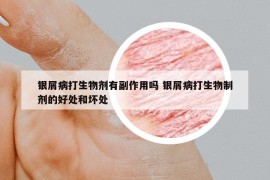 银屑病打生物剂有副作用吗 银屑病打生物制剂的好处和坏处