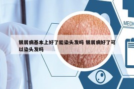 银屑病基本上好了能染头发吗 银屑病好了可以染头发吗