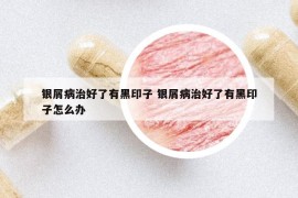 银屑病治好了有黑印子 银屑病治好了有黑印子怎么办