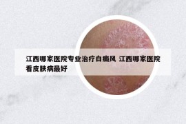 江西哪家医院专业治疗白癜风 江西哪家医院看皮肤病最好