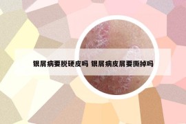 银屑病要脱硬皮吗 银屑病皮屑要撕掉吗