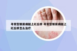 寻常型银屑病腿上红丘疹 寻常型银屑病腿上红丘疹怎么治疗