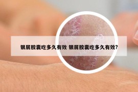 银屑胶囊吃多久有效 银屑胶囊吃多久有效?