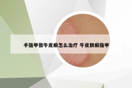 手指甲张牛皮癣怎么治疗 牛皮肤癣指甲