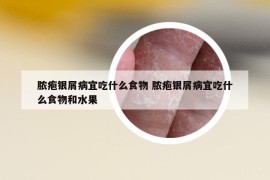 脓疱银屑病宜吃什么食物 脓疱银屑病宜吃什么食物和水果