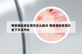 银屑病皮损处发热怎么解决 银屑病皮损发红老下不去咋办