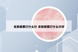 皮肤癣要打什么针 皮肤癣要打什么针好