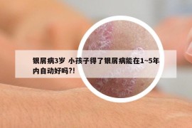 银屑病3岁 小孩子得了银屑病能在1~5年内自动好吗?!