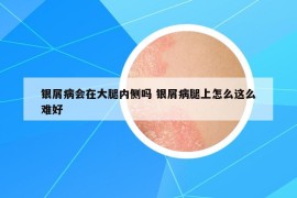 银屑病会在大腿内侧吗 银屑病腿上怎么这么难好