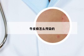 牛皮癣怎么传染的