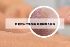 银翘散治疗牛皮癣 银翘癣病人图片