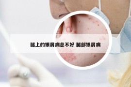 腿上的银屑病总不好 腿部银屑病