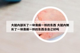 大腿内部长了一块像癣一样的东西 大腿内侧长了一块像癣一样的东西会自己好吗