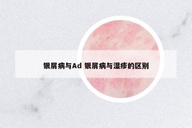 银屑病与Ad 银屑病与湿疹的区别