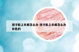 孩子脸上长癣怎么办 孩子脸上长癣怎么办 白色的