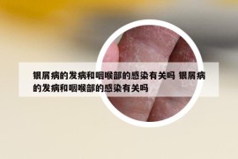 银屑病的发病和咽喉部的感染有关吗 银屑病的发病和咽喉部的感染有关吗