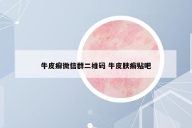 牛皮癣微信群二维码 牛皮肤癣贴吧