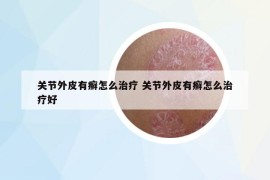 关节外皮有癣怎么治疗 关节外皮有癣怎么治疗好