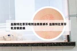 盐酸特比萘芬喷剂治银屑病不 盐酸特比萘芬乳膏银屑病